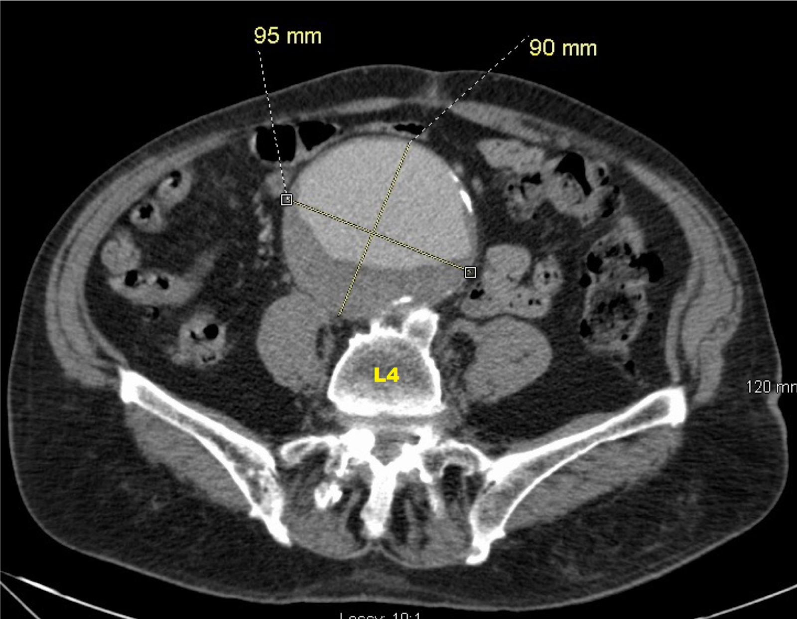 CT Scan of Patient
