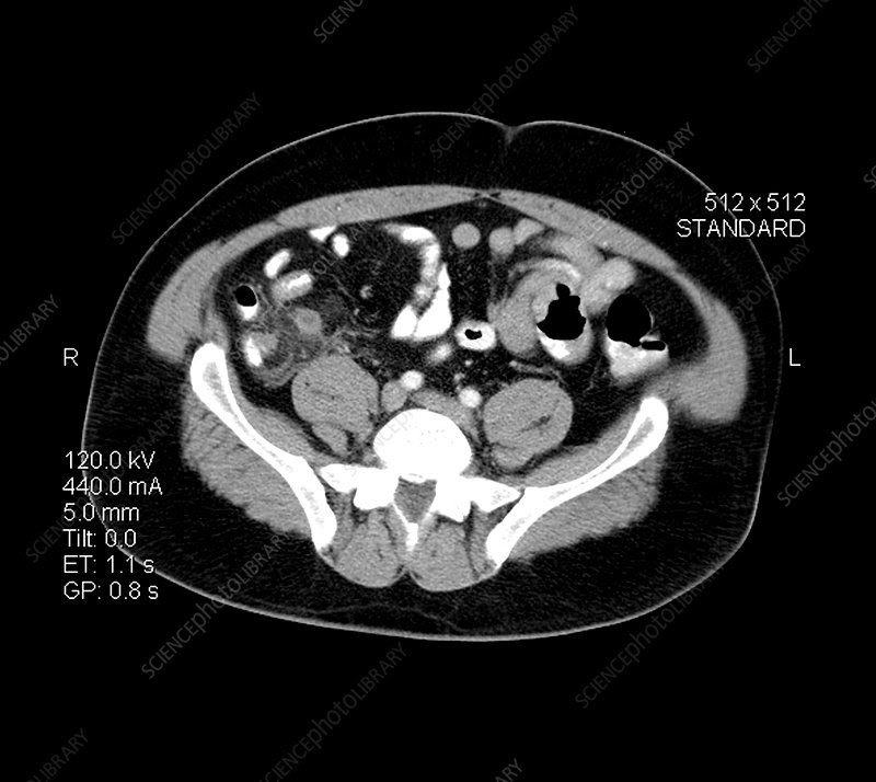 CT Scan of Ruptured Appendix